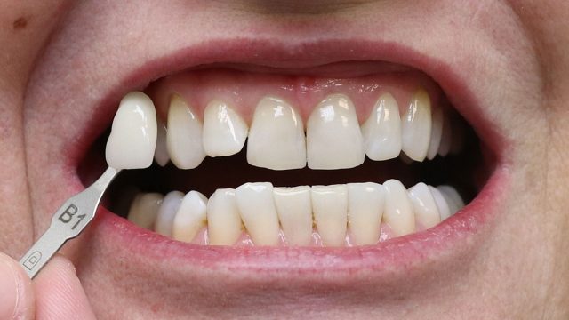 Stav po bělení zubů