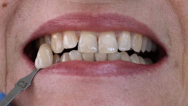 stav před bělením zubů